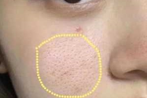 脸上毛孔粗大怎么治（脸上毛孔粗大怎么治疗）