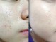 毛孔怎么才能缩小（毛孔怎么才能缩小呢）