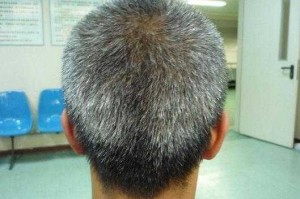 35岁有很多白头发是什么原因,头上有白头发吃什么好呢