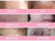粉刺痘痘怎么去除（粉刺痘痘怎么去除小妙招）