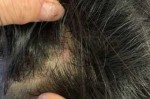 头皮上起痘痘怎么回事（头皮上起痘痘怎么回事儿）