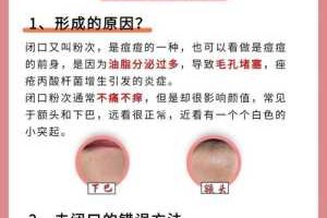 皮肤粉刺如何去除,粉刺怎么去除小妙招