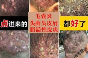 头皮上长痘痘，用什么药，而且头发很油又掉发,头顶掉发怎么治疗好