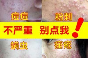 擦什么去痘印（脸上有痘印怎么消掉）