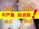 擦什么去痘印（脸上有痘印怎么消掉）
