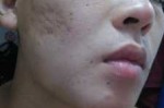 怎么清除青春痘（怎么清除青春痘男）