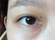 脸上很多脂肪粒怎么办（脸上长脂肪粒去除小妙招）