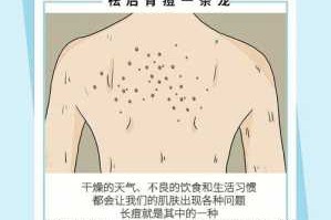 背上长痘怎么消除（背上长痘怎么消除最快）