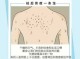 背上长痘怎么消除（背上长痘怎么消除最快）