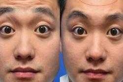 小男孩有抬头纹怎么办,17岁男孩有抬头纹怎么办