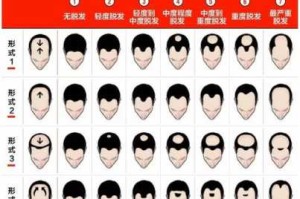 秃顶是为什么（秃顶是为什么引起的）