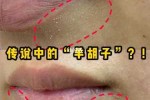 白头粉刺怎样去除,白粉刺怎么去除小妙招