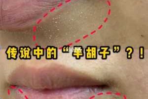 白头粉刺怎样去除,白粉刺怎么去除小妙招