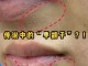 白头粉刺怎样去除,白粉刺怎么去除小妙招