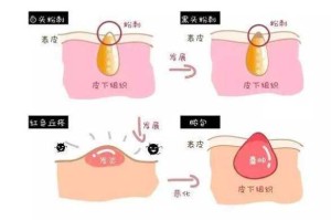 开口粉刺和闭口怎么区分（闭口和痘痘的区别）