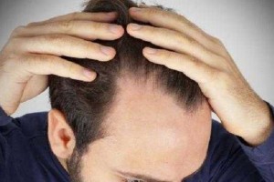 男士掉头发怎么办（男生掉头发很厉害怎么办才好）