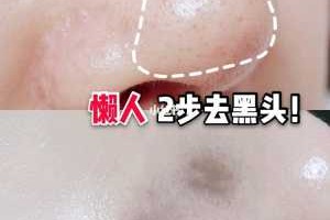 黑头怎么去除小窍门（黑头怎么去除最有效）