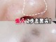 黑头怎么去除小窍门（黑头怎么去除最有效）