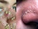 鼻头长痤疮怎么办（鼻头的痘痘怎么去除）