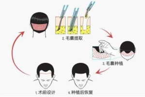怎么种好头发,头发怎么种植视频