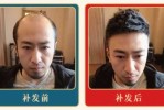 男性发际线后移怎么办（男士发际线后移怎么办）