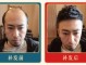 男性发际线后移怎么办（男士发际线后移怎么办）