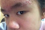 有粉刺怎么办（额头有粉刺怎么办）