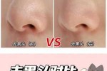 怎么样去鼻子黑头（怎么样去鼻子黑头最有效最快）