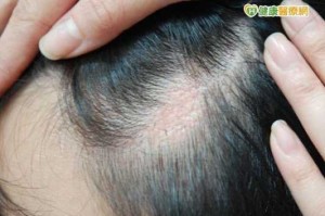 头发毛囊受损怎么办（烫头发头皮受损怎么修复）