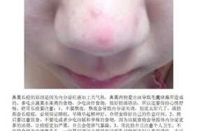 鼻子长痘痘什么原因（鼻子上面长痘痘原因）