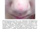 鼻子长痘痘什么原因（鼻子上面长痘痘原因）