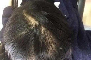 油性脱发怎么办（油性脱发怎么办?）
