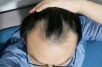 发际线向后推是怎么回事,发际线向后移是怎么回事