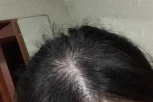 头顶好多碎头发怎么办（碎头发多怎么办）