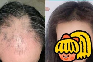 女生掉头发怎么回事,女人脱发是什么原因造成的