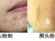 什么是闭合痘（什么是闭合痘痘）