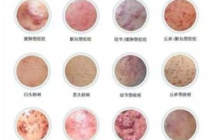 长痤疮是什么原因（长痤疮是什么原因引起的）