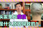 头发长痘痘是什么原因（头发里长痘痘是什么原因）