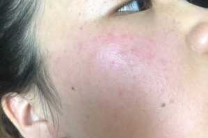 长酒刺怎么办（长酒刺怎么办）