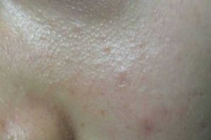 脸上长脂肪粒怎么办,脸总是长脂肪粒