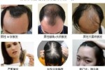 掉头发很厉害什么原因（掉发严重是什么原因）