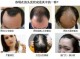 掉头发很厉害什么原因（掉发严重是什么原因）
