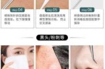 去黑头什么好用（去黑头是用粉刺针还是棉签）
