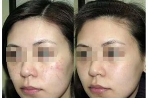 祛痘印怎么去（用维生素E去痘印怎么用？如何治疗痘印）