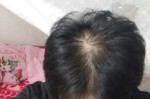 头顶的头发稀疏怎么办（头顶的头发稀疏怎么办）