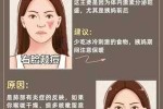 痤疮怎么消除（脸上的痤疮怎么消除）