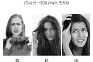 大把掉头发是什么原因（脱发是什么原因,治疗脱发最好的方法）