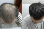头发少是什么病（头发少是什么病的前兆）