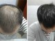 头发少是什么病（头发少是什么病的前兆）