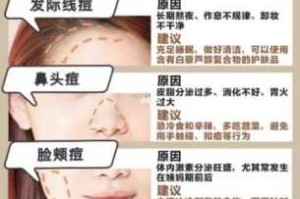 额头上长痘痘是怎么回事,额头两侧长痘痘是什么原因引起的
